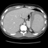 Herpesvirus 4, Human (Epstein Barr Virus)