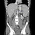 Herpesvirus 4, Human (Epstein Barr Virus)