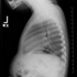 Haemophilus influenzae type b