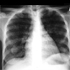 Mycobacterium tuberculosis