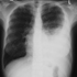 Mycobacterium tuberculosis