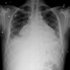 Mycobacterium tuberculosis