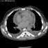 Mycobacterium tuberculosis