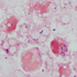 Streptococcus anginosus