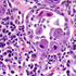 Cytomegalovirus