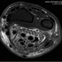 Mycobacterium avium Complex