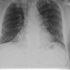 Mycobacterium tuberculosis