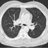 Mycobacterium tuberculosis