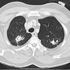 Mycobacterium tuberculosis