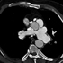 Mycobacterium tuberculosis