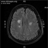 Bartonella