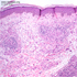 Mycobacterium leprae