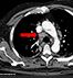 Histoplasma