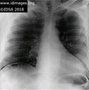 Mycobacterium tuberculosis