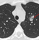 Histoplasma