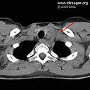 Histoplasma