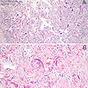 Strongyloides stercoralis