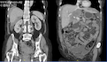 Mycobacterium tuberculosis