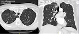 Mycobacterium tuberculosis