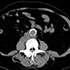 Mycobacterium bovis