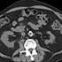 Mycobacterium bovis