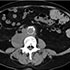 Mycobacterium bovis