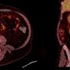 Mycobacterium bovis