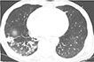 Nocardia