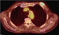 Nocardia