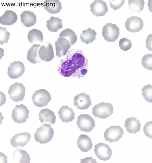 <p>A middle-aged woman had a 6-day history of fatigue, anorexia, fevers, chills, severe headache and myalgias, in late summer. She had recently hiked in New England and had a dog; she was not sexually active. The temperature was 103.5°F (39.7°C), blood pressure 104/50 mm Hg, and pulse 122 beats per minute; the remainder of the exam were normal. The peripheral blood smear is shown.</p>
<p><b>The most likely diagnosis is which of the following?</b></p>