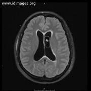 <p>A woman from Guatemala developed a bifrontal headache and fever. After sleeping for 24 hours, she was difficult to arouse, somnolent, confused, and unable answer questions or follow commands, with fever to 38.3°C (101.0°F). The pupils reacted sluggishly; extra-ocular movements were grossly intact.  The white cell count was 17,900 per cubic millimeter (neutrophils 14,770 per cubic millimeter).  MRI of the brain, FLAIR view, is <b>shown</b>.</p>
<p><b>The most likely diagnosis is which of the following?</b></p>