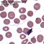 <p>A woman developed fevers to 102°F (38.9°C), aches, abdominal pain, and vomiting after visiting Lake Tahoe and the Sierra Nevadas the previous month. On the 5th day, the temperature was 102°F (38.9°C). The abdomen was tender, with a palpable spleen. The white count was 4300 cells/µl (normal 4000 - 11,000), with neutrophils 70% and bands 15%, and platelet count 18,000/µl (nl 150,000 - 400,000). The peripheral smear is <b>shown</b>.</p>
<p><b>The most likely diagnosis is which of the following?</b></p>