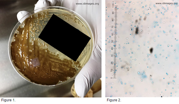 <p>A woman in her fifties with glioblastoma, on treatment with vancomycin via a percutanously inserted central catheter (PICC) for a Staphylococcal surgical site scalp infection, presented with fevers and chills. Blood cultures drawn on the day of presentation became positive 5 days later. Gram and Calcofluor white stains of the blood culture broth showed yeast-like forms. Two days later, scant growth of a dark flat colony was noted on Sabouraud Dextrose agar (Figure 1). A lactophenol cotton blue stain of the colony showed yeast-like cells (Figure 2). Two weeks later, the colony was stained again, showing brown septated hyphae.</p>
<p><b>The most likely diagnosis is which of the following?</b></p>