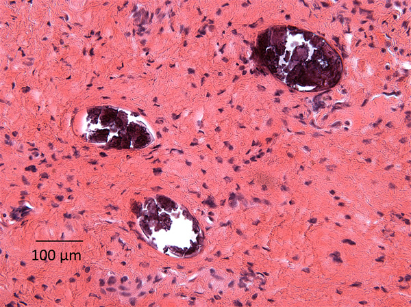 <p>A recent immigrant from West Africa underwent an elective total vaginal hysterectomy for uterine prolapse and fibroids. Specimens from the uterus, cervix and fibroid were sent for histopathological examination. What is the diagnosis?</p>
