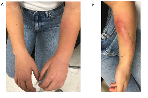 A young girl presents with a progressively tender and swollen left forearm despite 2 days of intravenous cefazolin followed by 9 days of ceftriaxone, administered via outpatient parenteral antibiotic therapy (OPAT). She was afebrile. Photographs of her left forearm taken on the day of initial presentation (A) and day 11 (B) of antibiotics are shown. What is the diagnosis?
