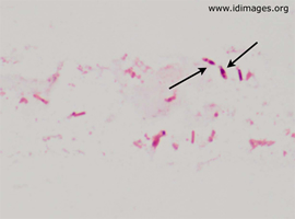 Figure 2.  Gram stain of <i>Clostridium septicum</i> from soft tissue swab, with arrows showing endospores.