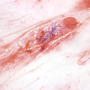 Nocardia