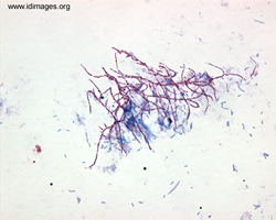 Figure 4.  <i>Nocardia nova</i> shown by modified acid fast stain of growth from modified Thayer Martin plate.