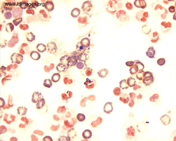 Figure 3.  Gram stain of cerebrospinal fluid, with  Streptococcus Group B.  