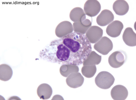 Figure 1.  Peripheral blood smear with morula of  Anaplasma.