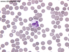 Figure 2.  Peripheral blood smear with morula of Anaplasma.