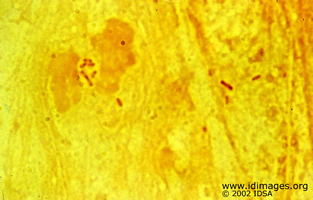 Figure 1.  Gram stain of sputum showing  <i>Burkholderia pseudomallei</i>.