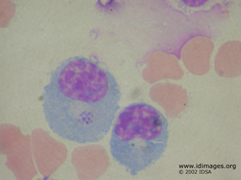 Figure 1.  Wright stain of cerebrospinal fluid  showing intracytoplasmic <i>Ehrlichia chaffeensis</i>.