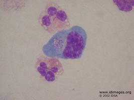 Figure 2. Wright stain of cerebrospinal fluid  showing intracytoplasmic <i>Ehrlichia chaffeensis</i>.	