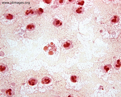 Figure 3.  Gram stain of aspirate showing  <i>Pasteurella multocida</i>. 