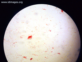 Figure 1.  <em>Pseudomonas aeruginosa</em> on gram stain.