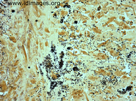 Figure 4.  Salmonella, group B, seen in Steiner stain  of resected mycotic aneurysm.  