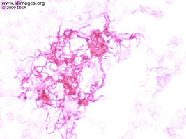 Figure 1.  Gram stain of <i>Streptobacillus moniliformis</i>  from anaerobic blood culture.