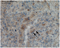 Figure 3.  <i>Treponema pallidum</i> on silver stain  of biopsy.