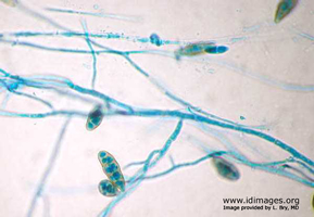 Figure 1.  <i>Alternaria</i>, shown by lactophenol blue stain  (40x  magnification)